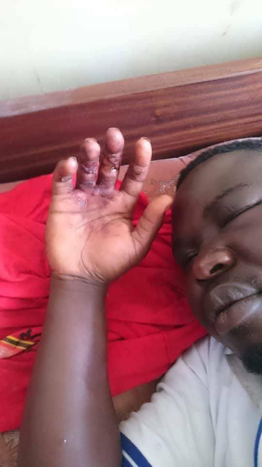 PHOTOS: Mityana MP Francis Zaake's Torture Pictures Leak - The Ugandan